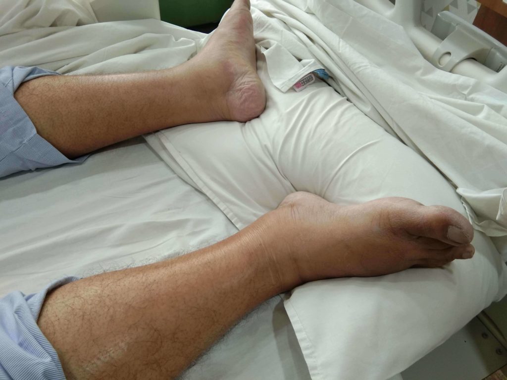 Severe edema